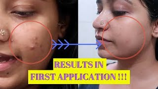 Acne Treatment For PCOS | Natural Home Remedy for PCOD Cystic Acne