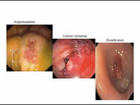 Persistent Lower GI Bleeding - R. Coimbra, MD