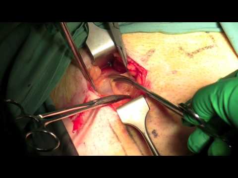 Direct Inguinal Hernia Surgery Repair With Mesh