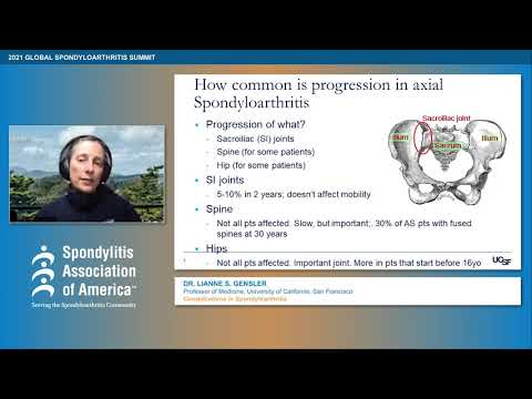 Complications in Spondyloarthritis