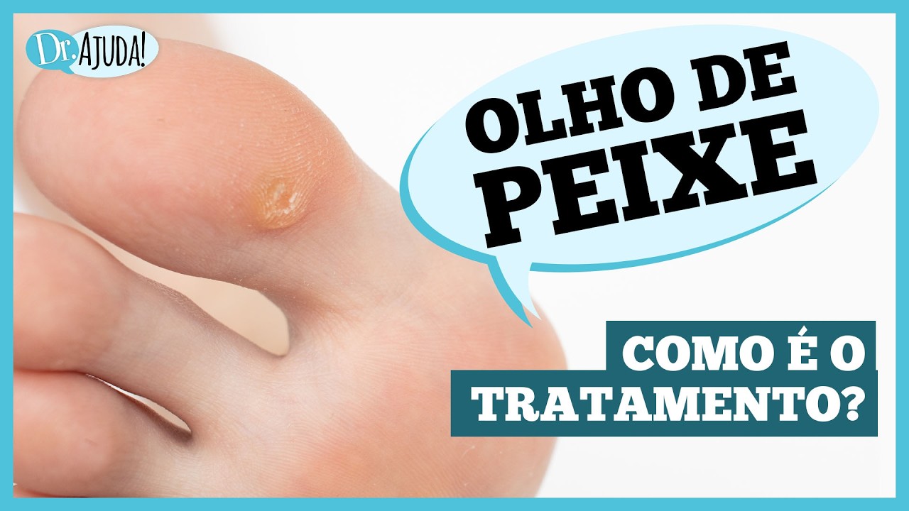 O que é o OLHO DE PEIXE? 🐟 Como se pega? Qual o tratamento? #dermatologia #hpv #verrugaplantar