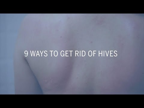9 Ways to Get Rid of Hives | Health