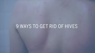 9 Ways to Get Rid of Hives | Health