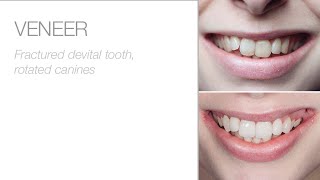 edelweiss VENEER – Patient Story