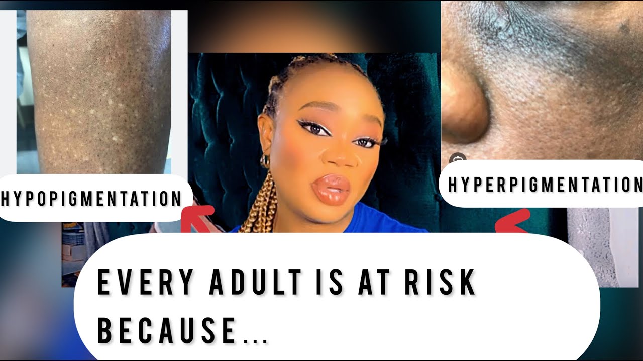 Hypopigmentation vs Hyperpigmentation ~ All you need to know | What are you dealing with…