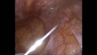 TPEA Lifter - Ovarian Suspension