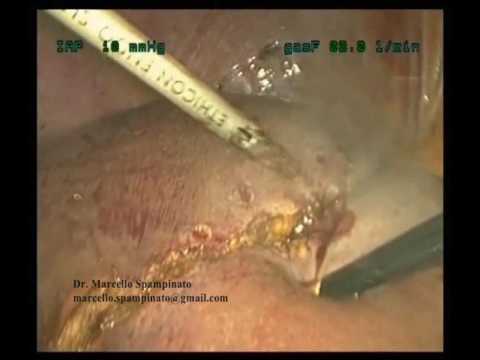 Technique of Laparoscopic Parenchymal Liver Transection for Major Hepatectomy Video