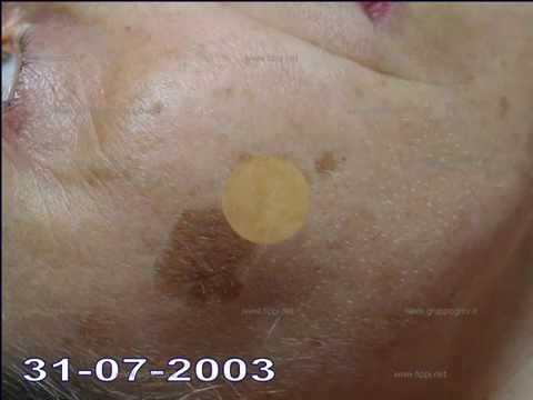 Siccome la decolorazione della persona è possibile Come candeggiare lentiggini nellestate