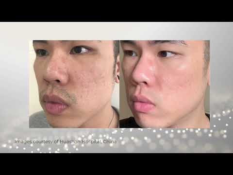 NEOGEN PLASMA - How does it work