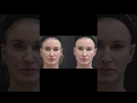 Smooth Acne Scars & Firm Skin | Virtue RF Microneedling