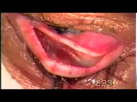 Surgery for Entropion-trichiasis, using Fugo blade Video