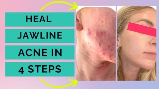 Jawline Acne - 4 steps to clear cystic acne on your jawline naturally