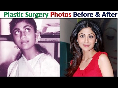 Top Plastic Surgery Photos Of Popular Bollywood Actresses - Before & After