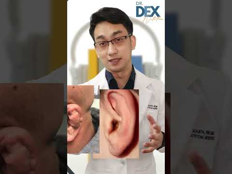Nabibingi ka?? #oneminutewiser #hearing #hearingloss #hearingproblems #ears
