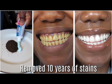 in two minutes remove 10 years of stains from teeth!! Results will Shock You