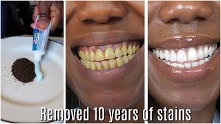 in two minutes remove 10 years of stains from teeth!! Results will Shock You