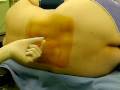 spinal anesthesia