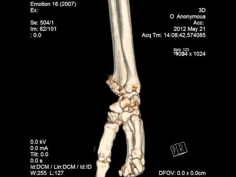 Artroza artrita articulațiilor mâinilor
