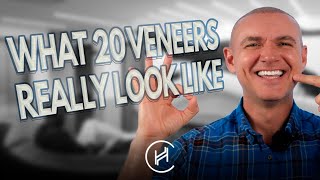 He Left Turkey With 6000 Grafts AND a Brand New Smile | Hair Transplan