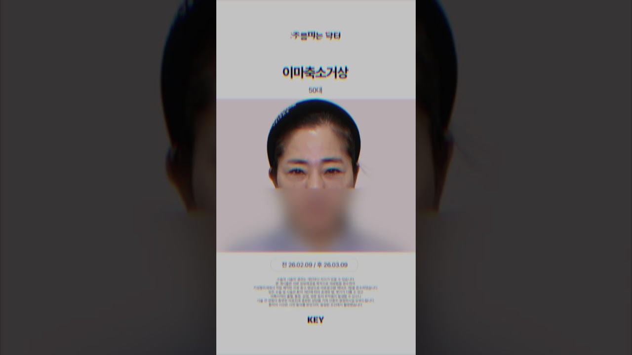 50대 이마축소거상