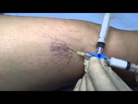 tratamentul varicozei varicose laser gomel