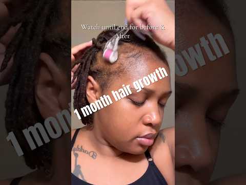 1 month Hair growth journey! #minoxidil #hairgrowth #hairgrowthchallange #baldinghair #hairloss