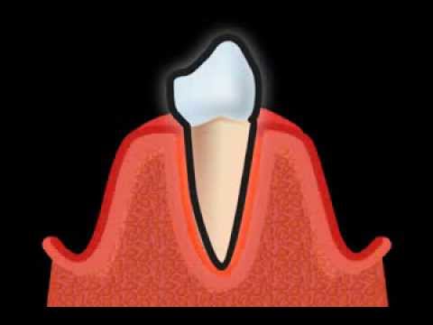 wenn Ihr Zahnarzt von Parodontose spricht, wird er Ihre Parodontitis nicht heilen