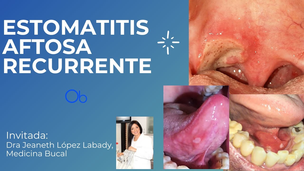 Estomatitis aftosa recurrente 👄 👅