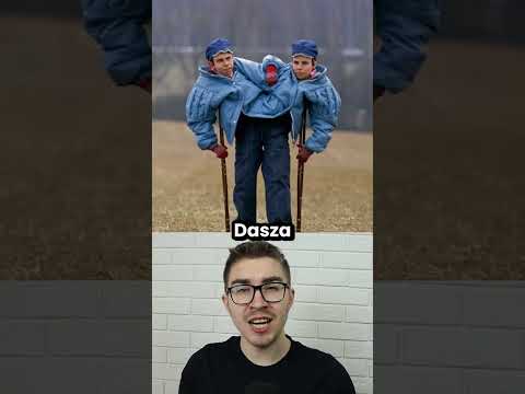 Co gdy jeden bliźniak syjamski chce się rozdzielić a drugi nie?