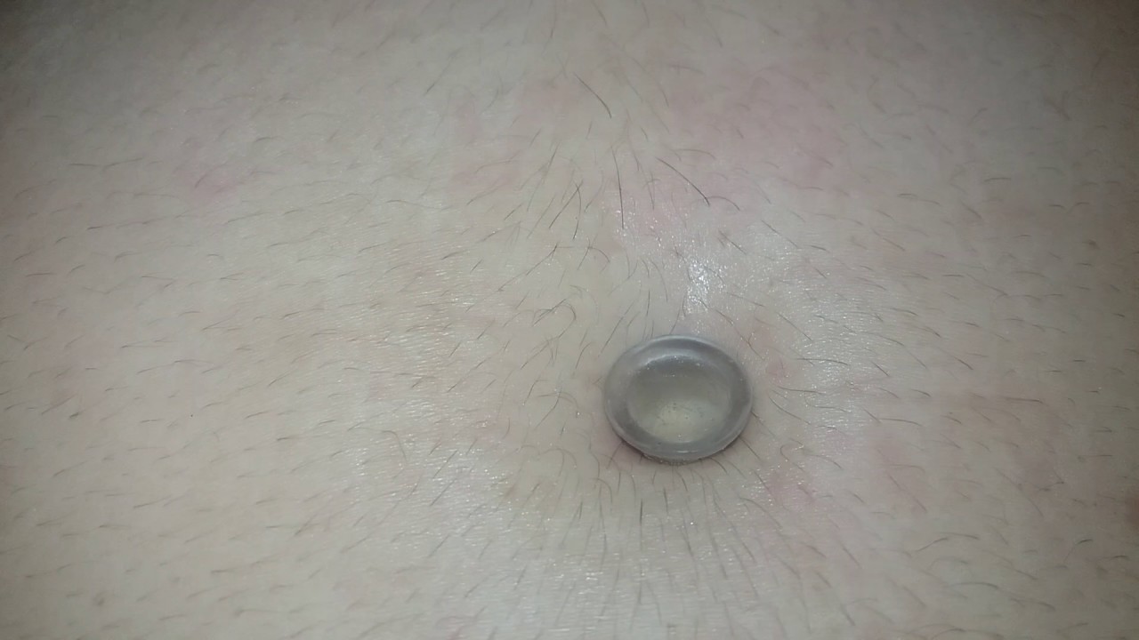 Órtose umbilical - 36 dias