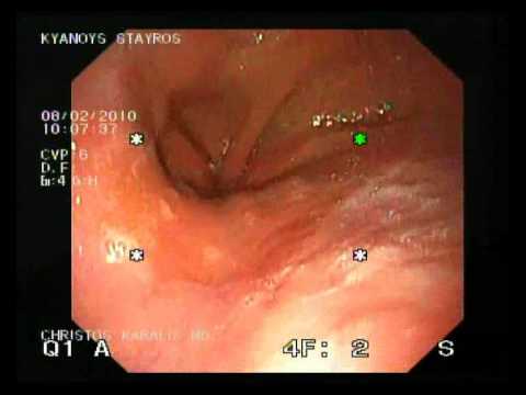 Ulcetarice Esophagitis After Gastric Band