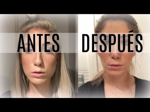 BOTOX para el BRUXISMO | ANTES Y DEPUÉS | ¿Funciona? | ¡Cambio de LOOK!