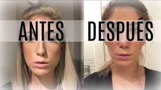 BOTOX para el BRUXISMO | ANTES Y DEPUÉS | ¿Funciona | ¡Cambio de LOOK!