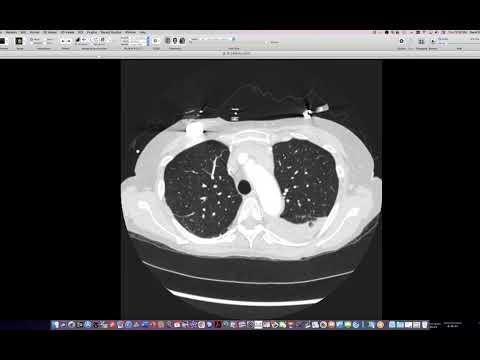 STR Cardiothoracic Case Webinar 1/6/2022