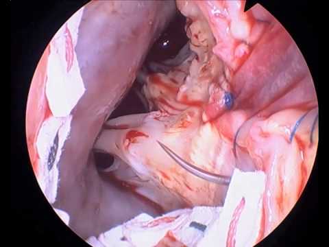 Cormatrix Patch Aortic Root Enlargement 