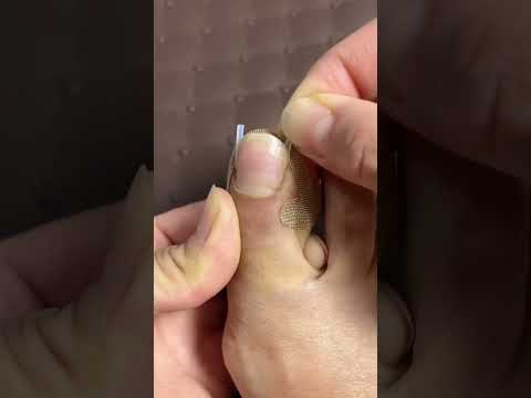 Product Link in Bio (#429 ) ✅ Toe Align Ingrown Nail Corrector Stickers #shorts