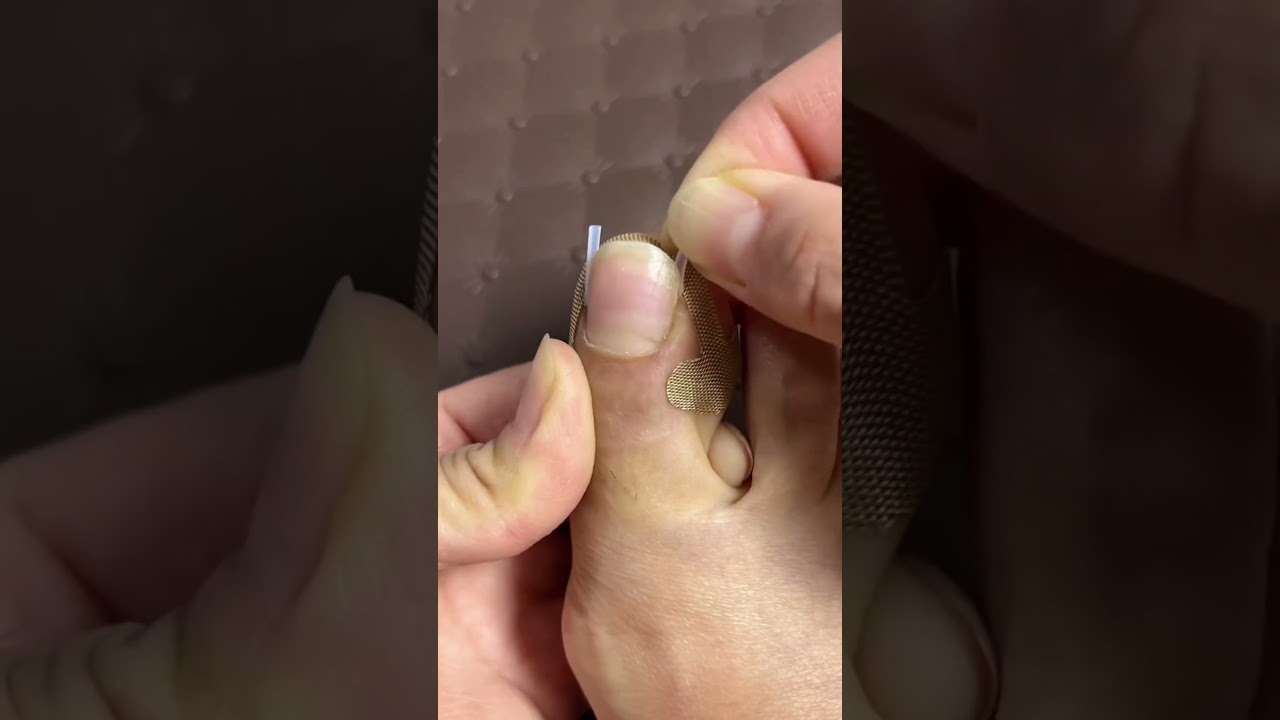 Product Link in Bio (#429 ) ✅ Toe Align Ingrown Nail Corrector Stickers #shorts