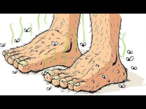 3 stopnie Valgus spłaszczenia Szczep gatunku diagnoza i leczenie zatrzymania