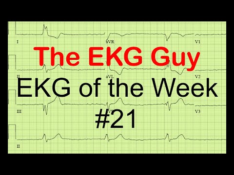 EKG/ECG of the Week #21 | The EKG Guy - www.ekg.md