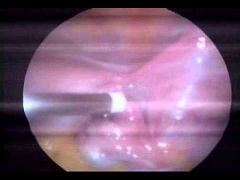 tubectomy tamboli yelale hospital Video