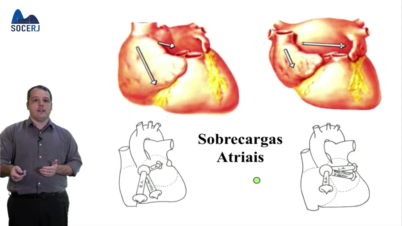 Curso Básico de ECG - Aula 03:  Confecção de Laudo Eletrocardiográfico