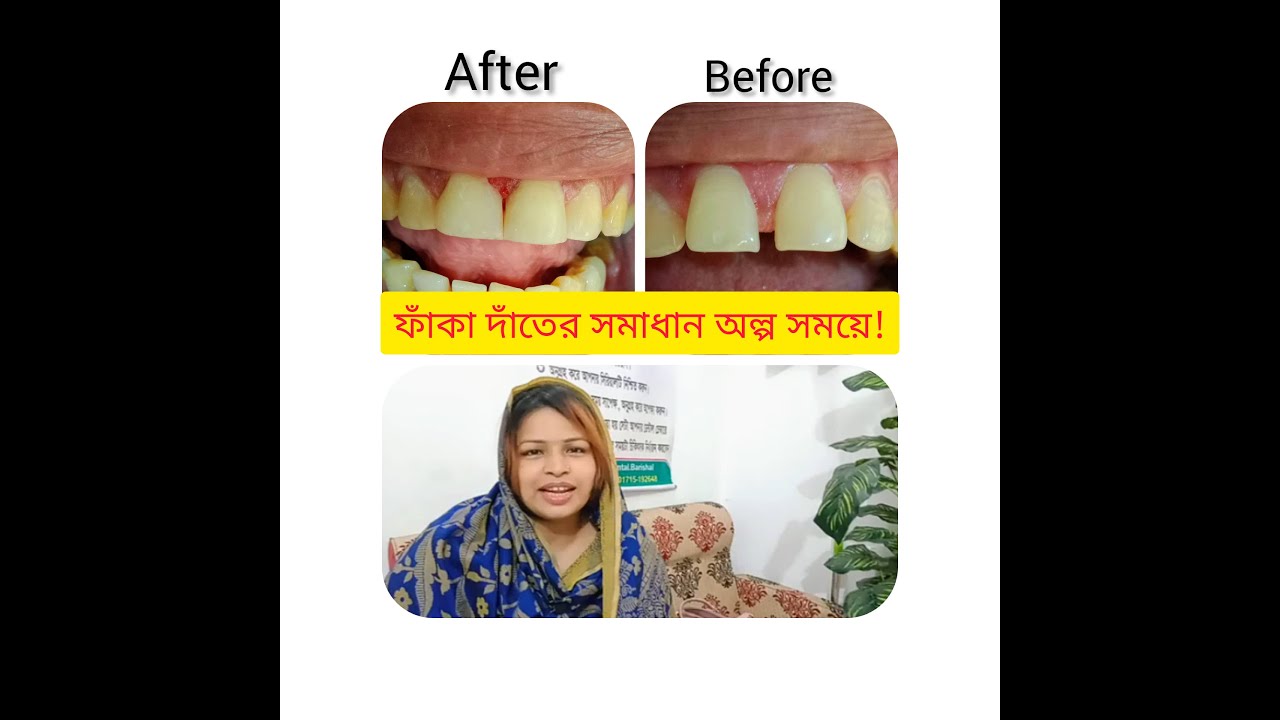 অল্প সময়ে ফাঁকা দাঁতের সমাধান, ডাক্তারকে ধন্যবাদ! - Video Review