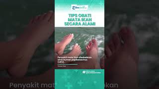 Mata Ikan Bikin Kulit Keras hingga Terasa Sakit, Begini Cara Tepat Mengobati dengan Bahan Alami