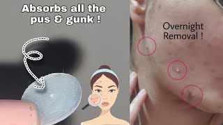 How to treat Puss filled Acne Overnight ?  #shorts