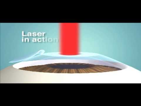 image-What is Advanced Surface Ablation (ASA) eye surgery?