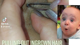 Underarm Ingrown Hair Removal -  satisfying to watch