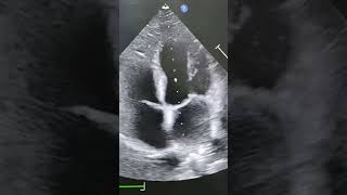 Download lagu 'Apical 4-Chamber View: Echocardiography window to see through your Heart' mp3