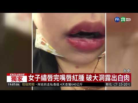 疑免疫力下降 女繡唇誘發皰疹感染!