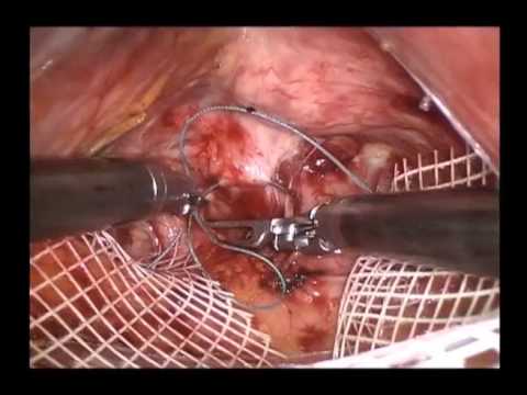 Robot-assisted Sacrocolpopexy For Pelvic Organ Prolapse: Surgical Technique And Outcomes