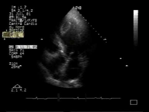 Left Ventricular Apical Cystic Thrombus (2/2)